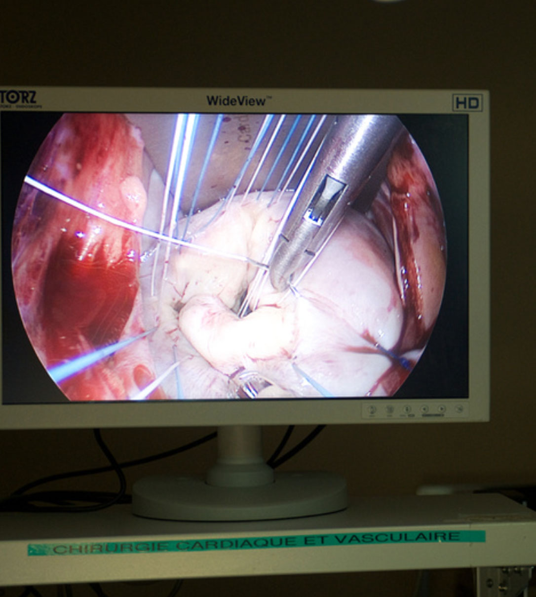 Chirurgie Cardiaque Mini-invasive