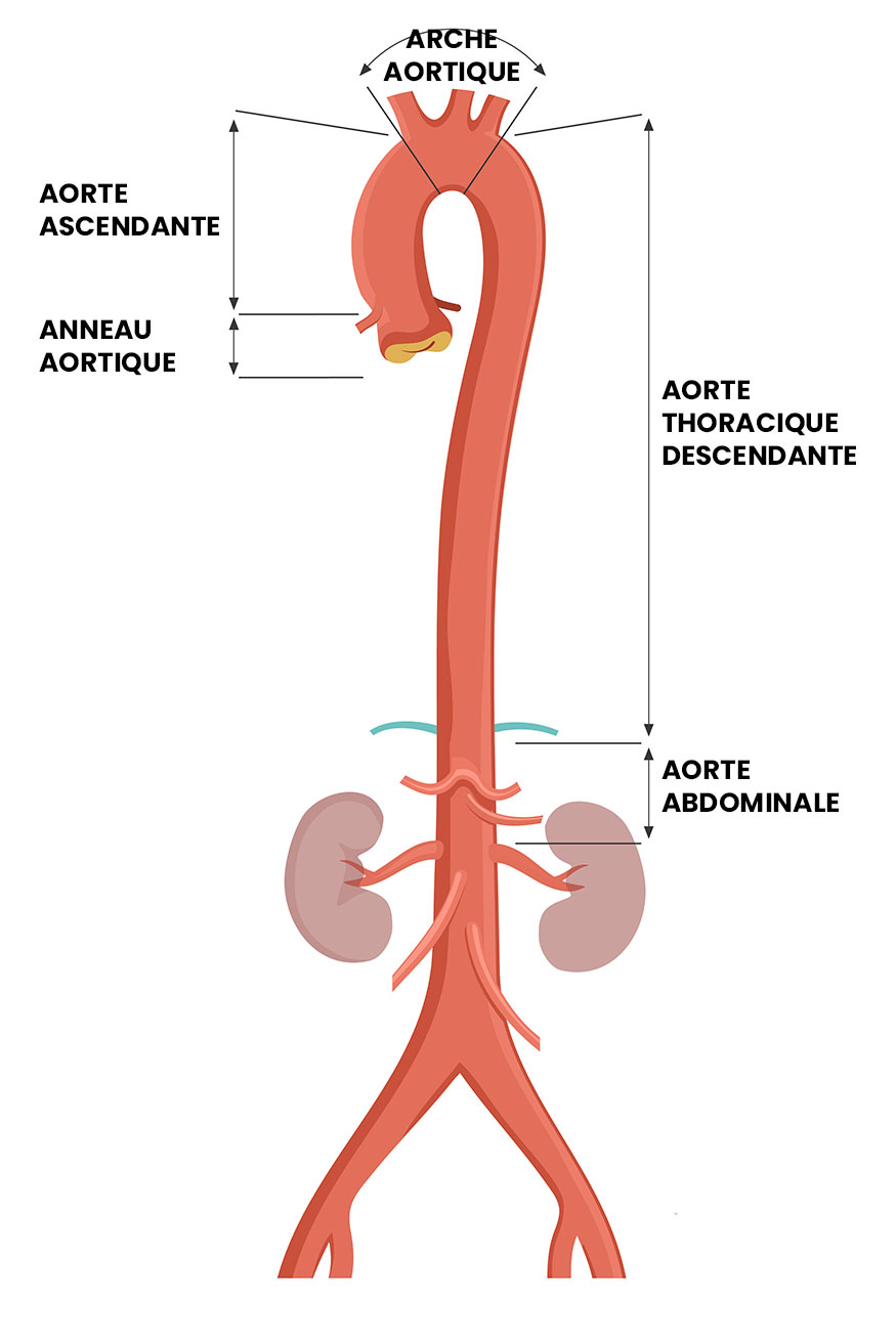 Chirurgie de l'aorte