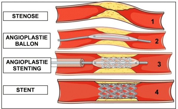 Angioplastie stent