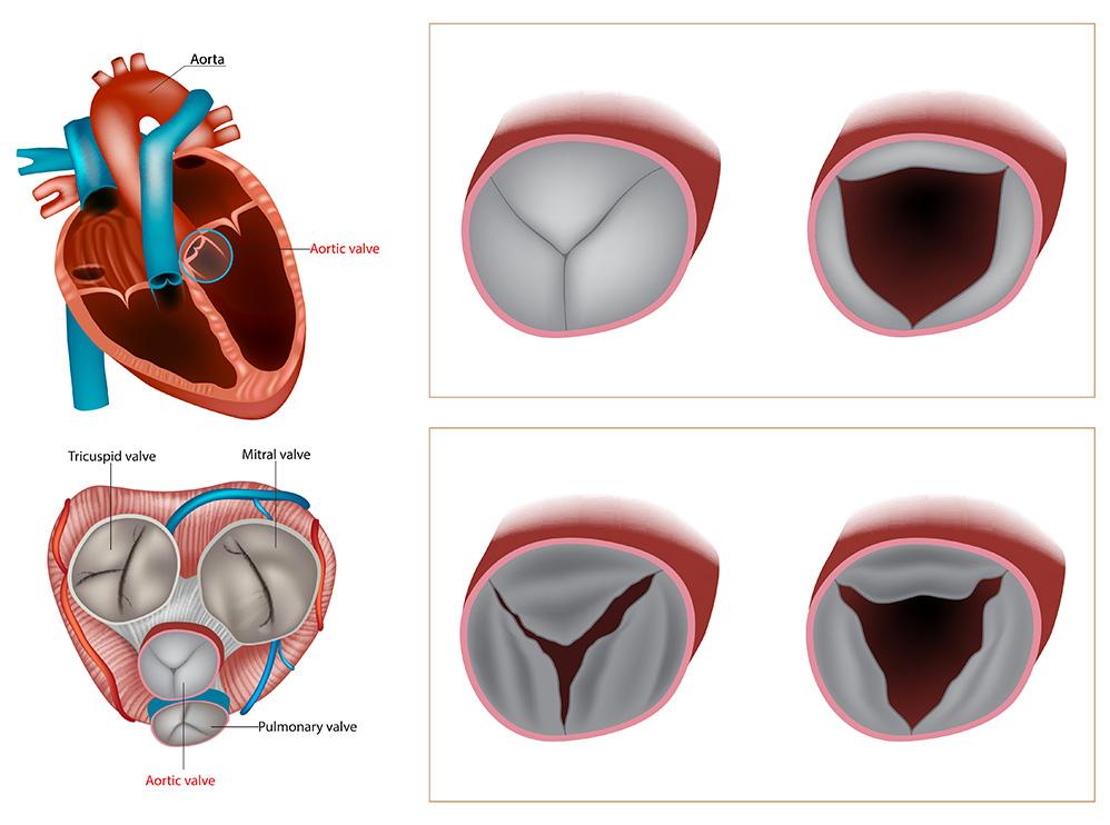 chirurgie des valves cardiaques